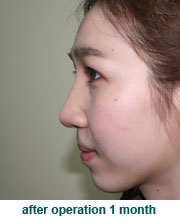 plastic_surgery_augmentation_rhinoplasty